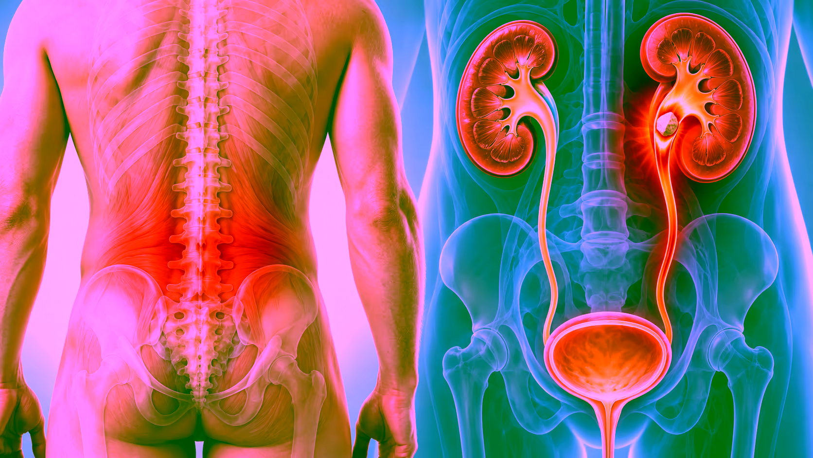 Minh hoạ phân biệt đau lưng và đau do sỏi thận