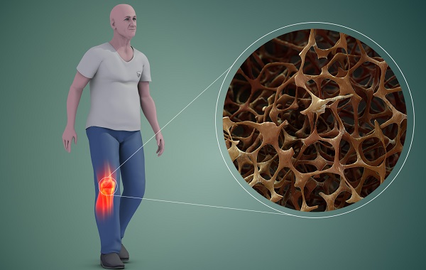 Hình ảnh mô phỏng cấu trúc xương bị loãng xương ở nam giới