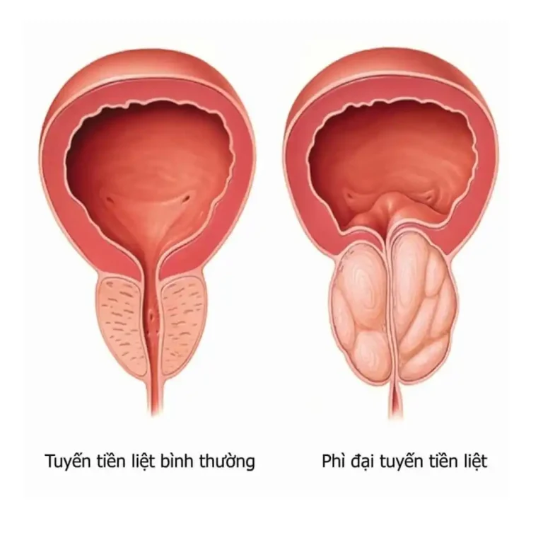 Hình ảnh minh họa so sánh tuyến tiền liệt bình thường và tuyến tiền liệt bị phì đại