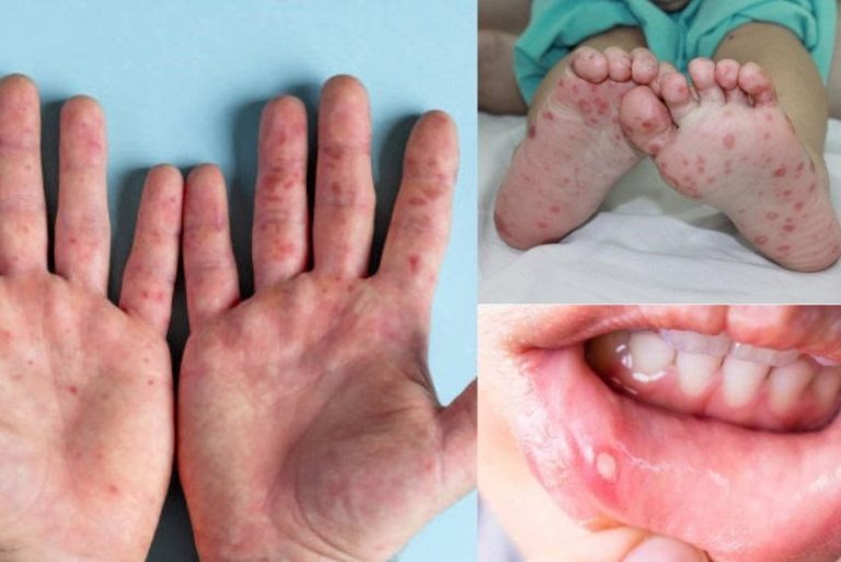 Hình ảnh minh họa các nốt phỏng nước đặc trưng của bệnh tay chân miệng trên tay và chân trẻ
